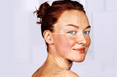 Rosacea Causes And Treatments Coming Soon! Image 